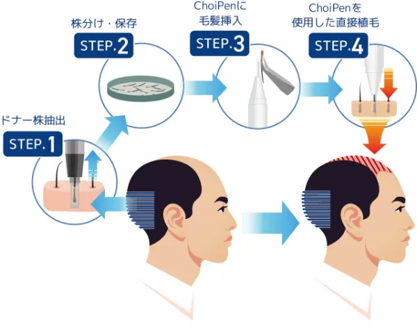 自毛植毛「DHI法」